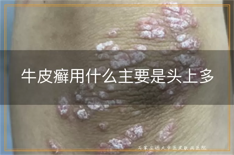 牛皮癣用什么主要是头上多