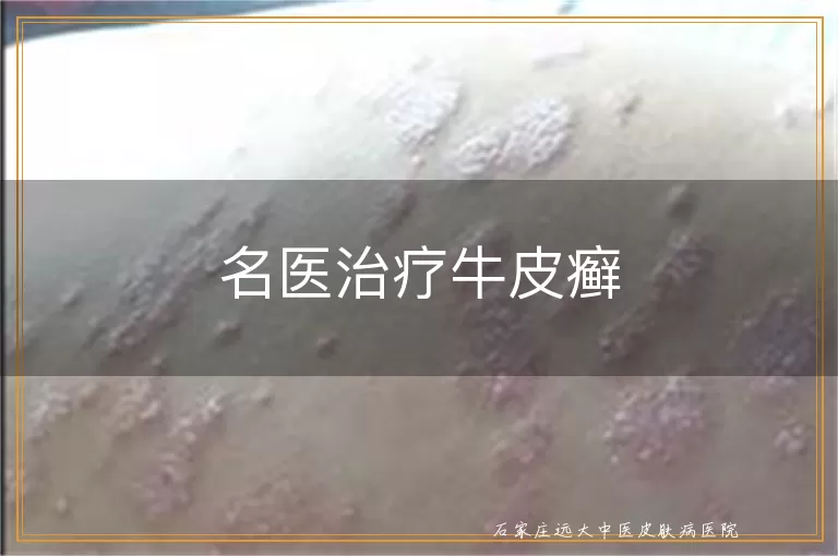 名医治疗牛皮癣