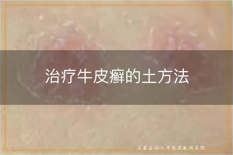 治疗牛皮癣的土方法