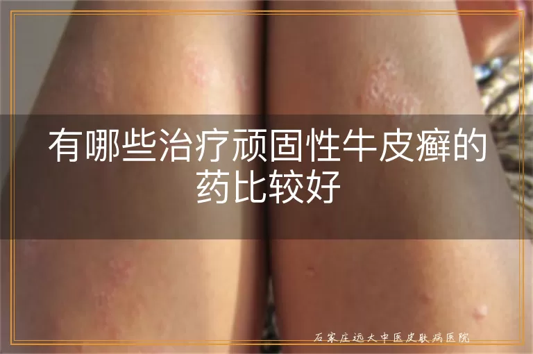 有哪些治疗顽固性牛皮癣的药比较好