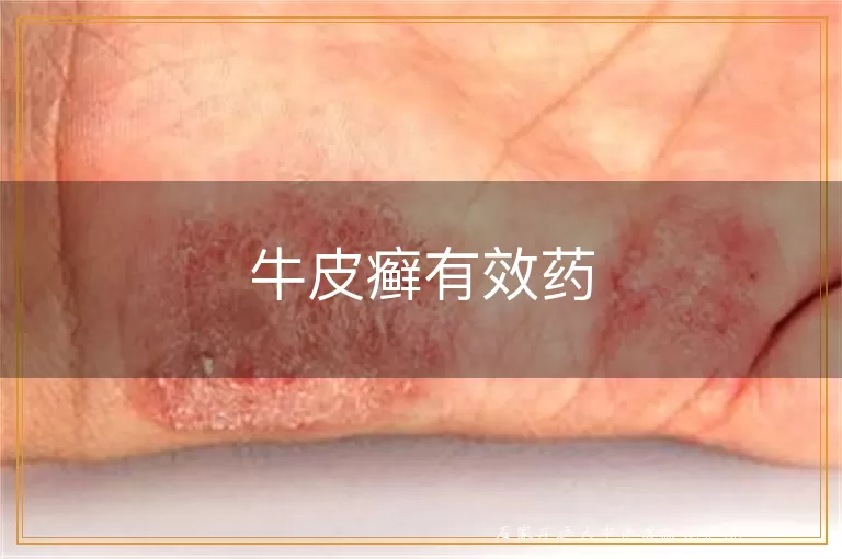 牛皮癣有效药