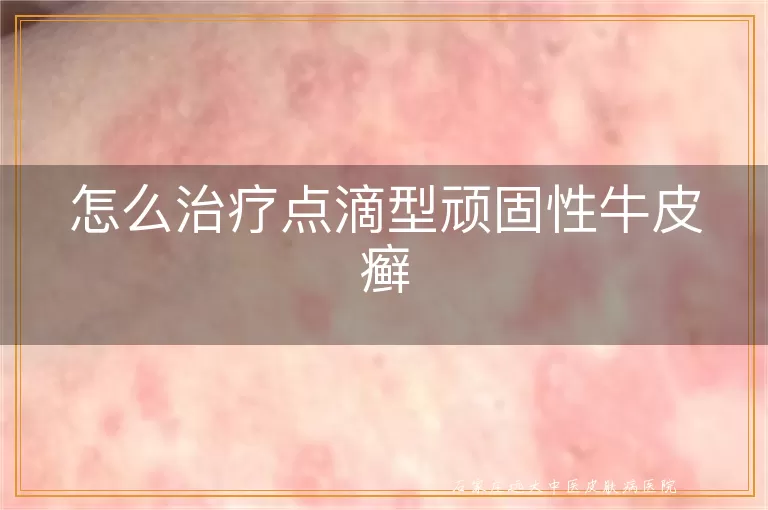 怎么治疗点滴型顽固性牛皮癣