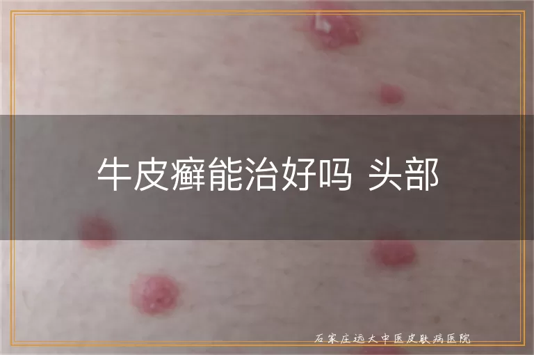 牛皮癣能治好吗 头部