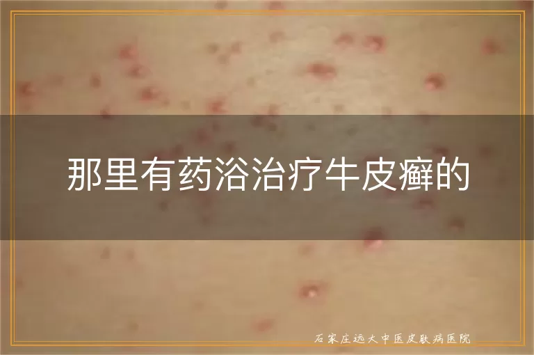 那里有药浴治疗牛皮癣的