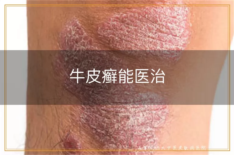 牛皮癣能医治