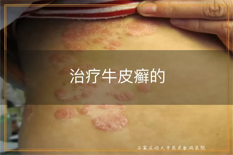 治疗牛皮癣的