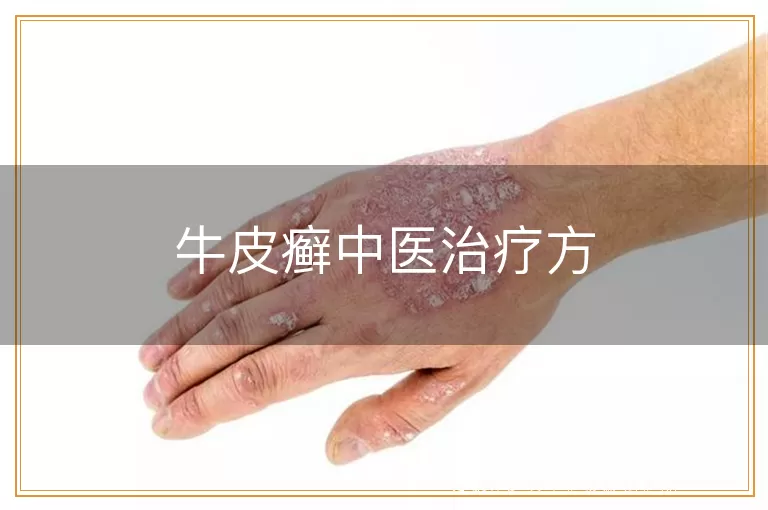 牛皮癣中医治疗方
