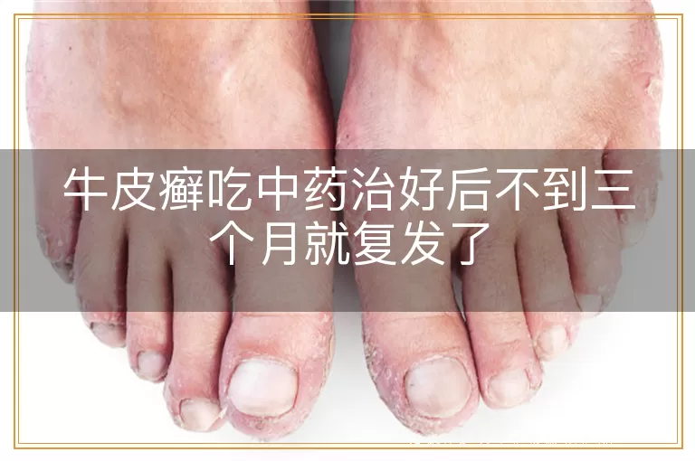 牛皮癣吃中药治好后不到三个月就复发了