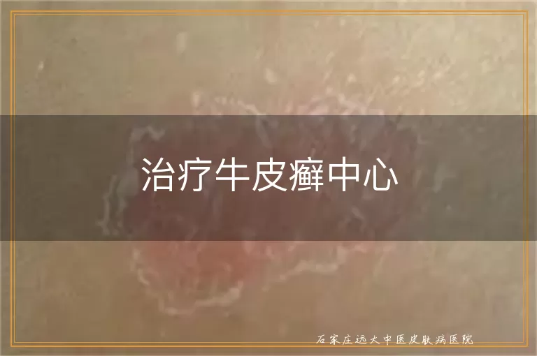 治疗牛皮癣中心