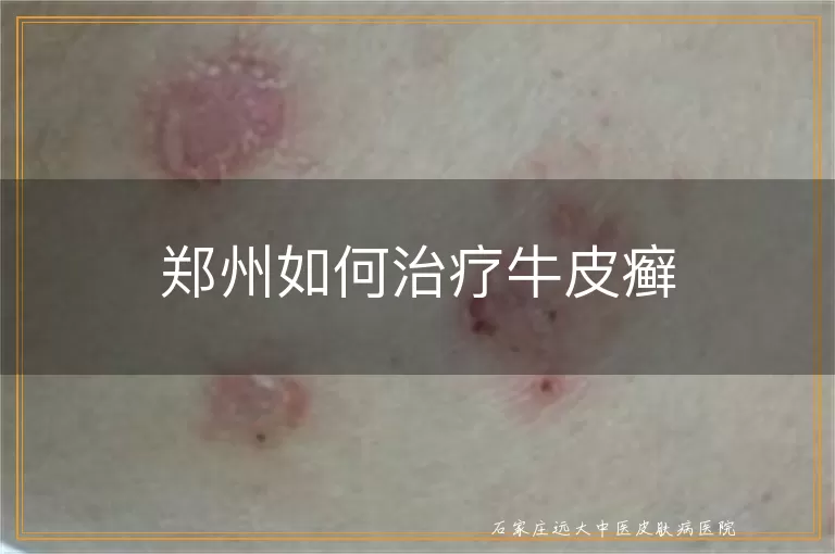 郑州如何治疗牛皮癣
