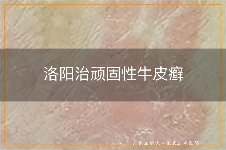 洛阳治顽固性牛皮癣