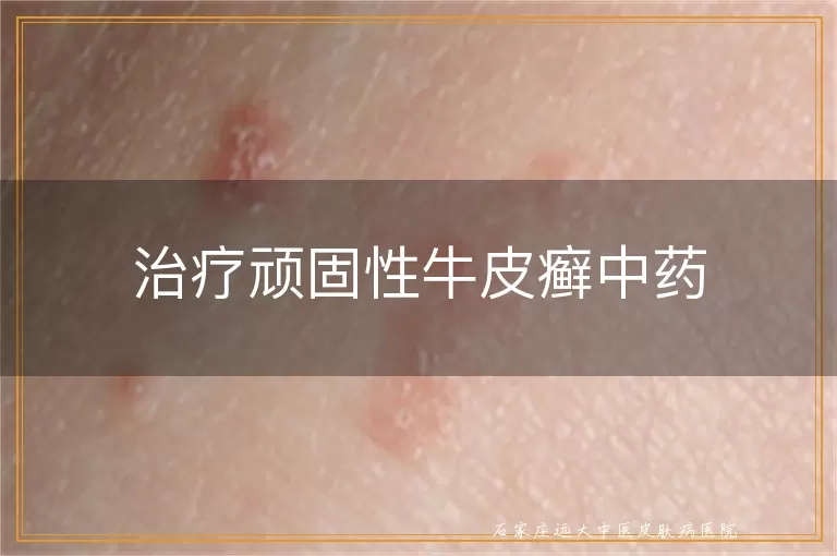 治疗顽固性牛皮癣中药