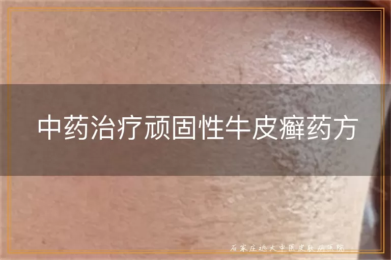 中药治疗顽固性牛皮癣药方