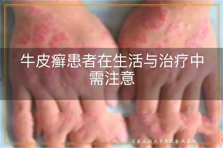 牛皮癣患者在生活与治疗中需注意