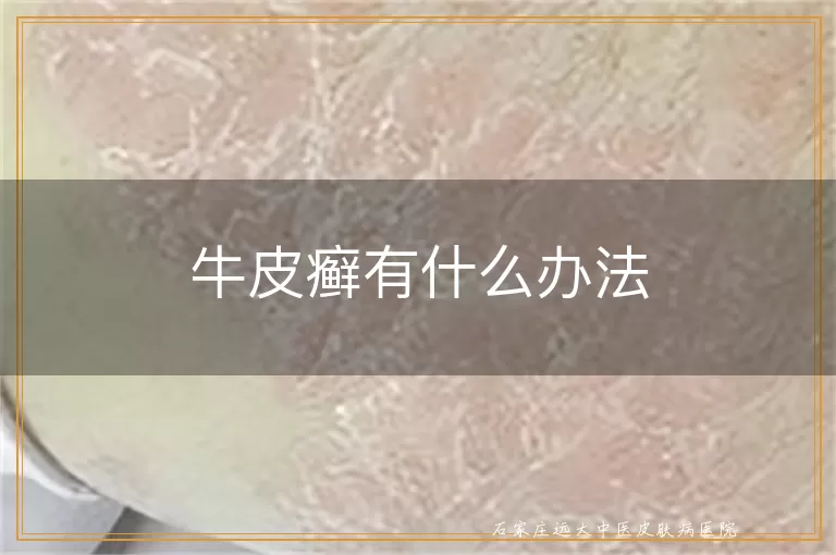 牛皮癣有什么办法