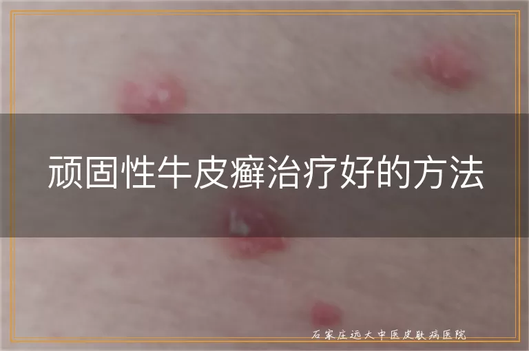顽固性牛皮癣治疗好的方法
