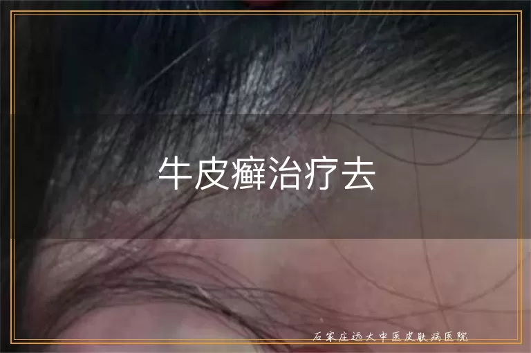 牛皮癣治疗去