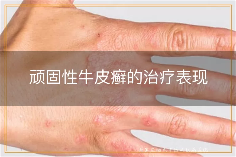 顽固性牛皮癣的治疗表现