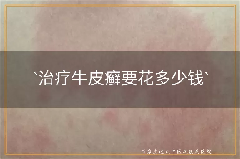 治疗牛皮癣要花多少钱