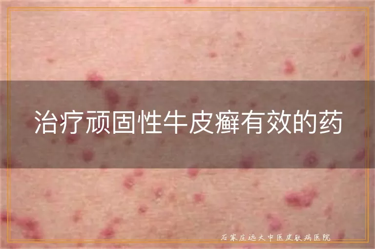 治疗顽固性牛皮癣有效的药