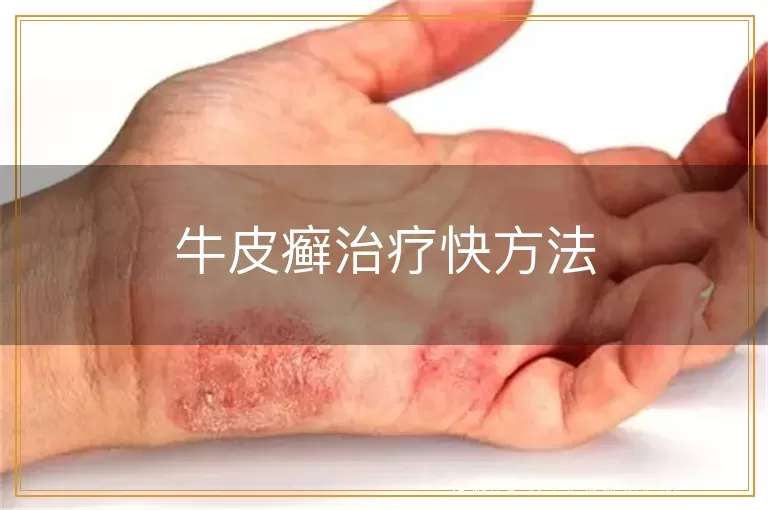 牛皮癣治疗快方法