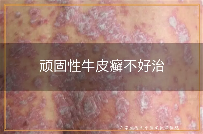 顽固性牛皮癣不好治