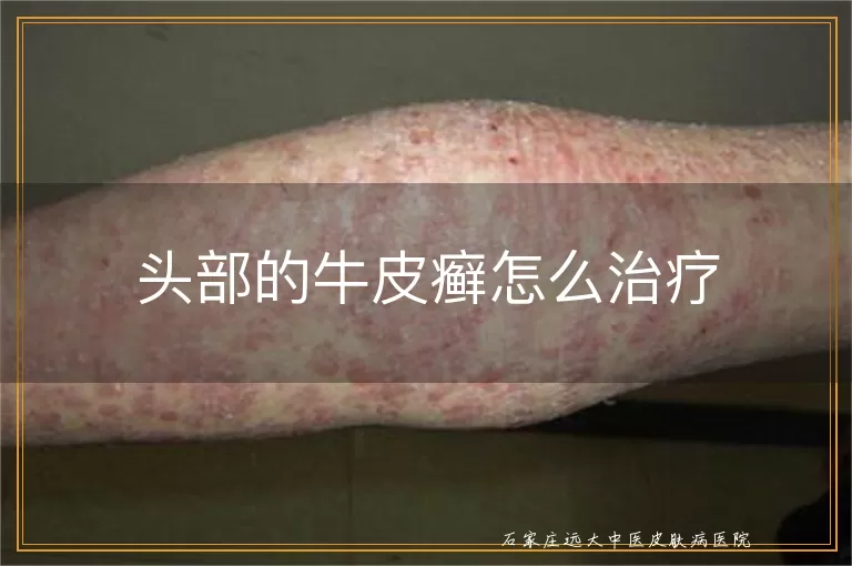 头部的牛皮癣怎么治疗