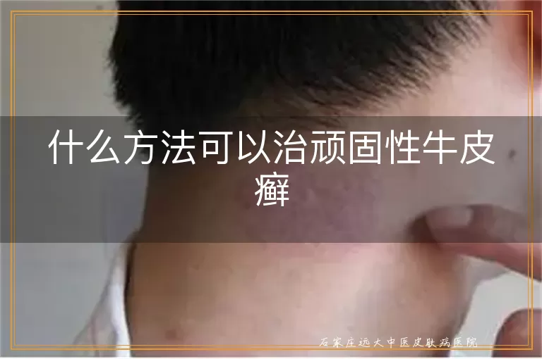 什么方法可以治顽固性牛皮癣