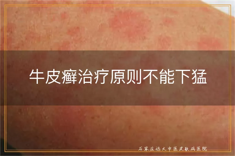 牛皮癣治疗原则不能下猛