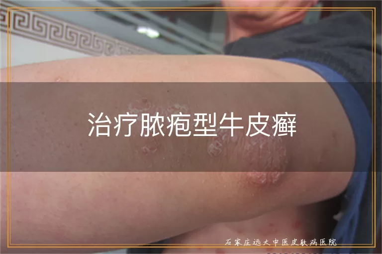 治疗脓疱型牛皮癣