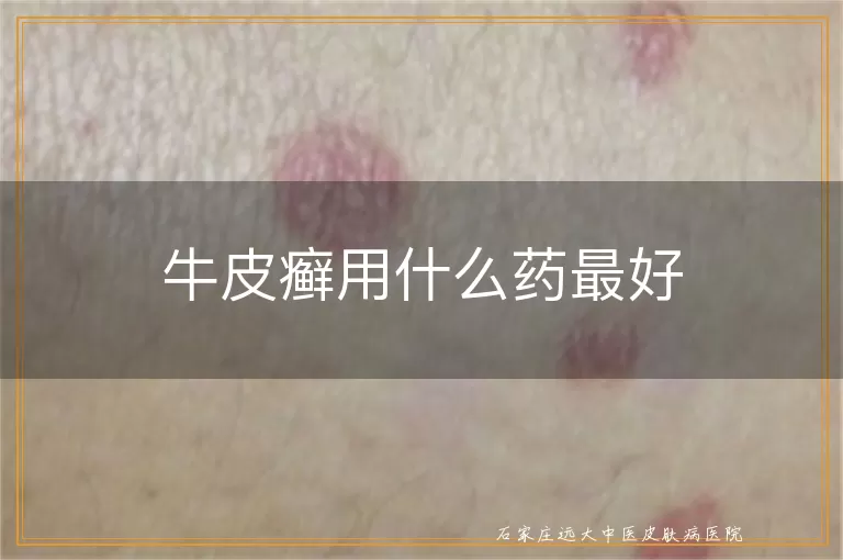 牛皮癣用什么药最好