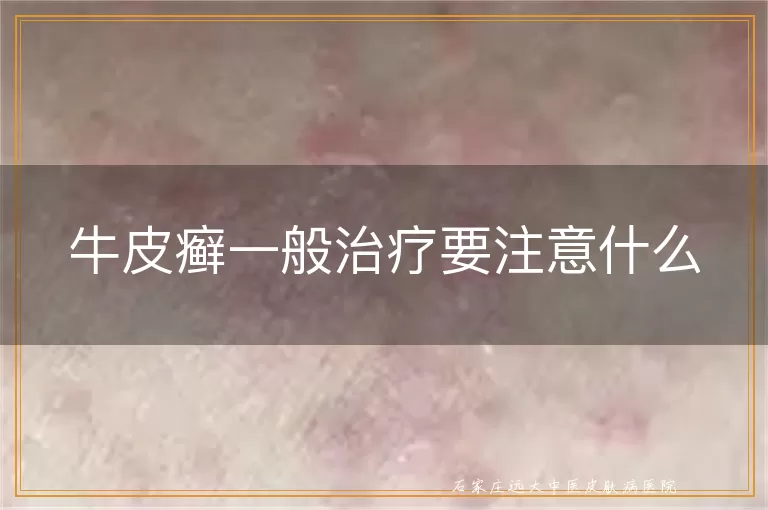 牛皮癣一般治疗要注意什么