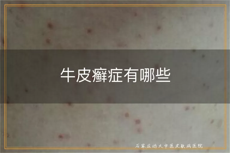 牛皮癣症有哪些