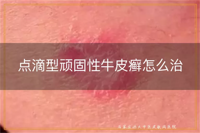 点滴型顽固性牛皮癣怎么治
