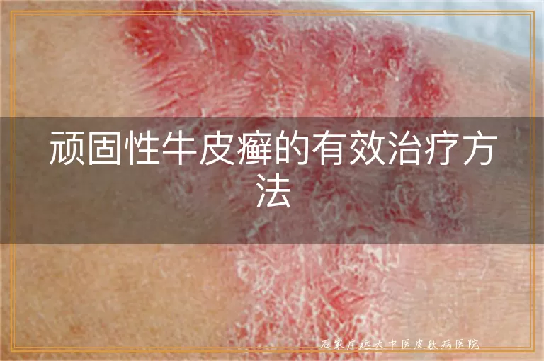 顽固性牛皮癣的有效治疗方法