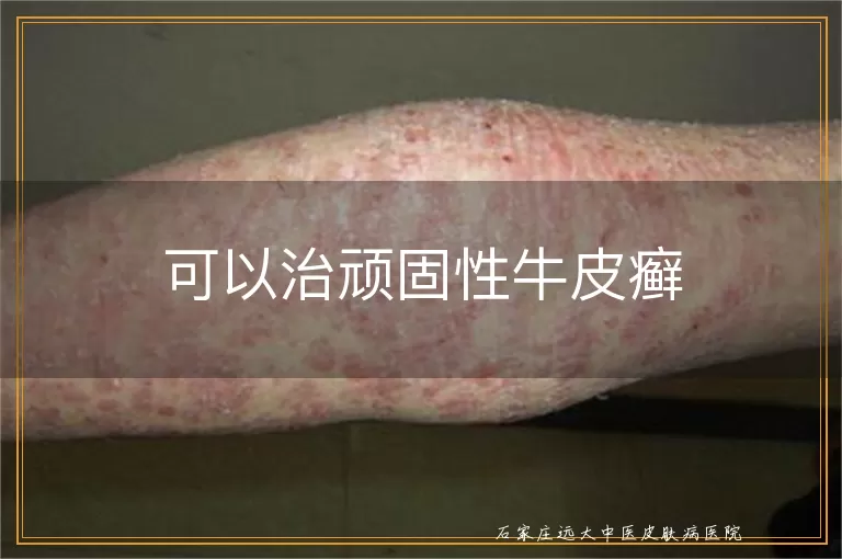 可以治顽固性牛皮癣