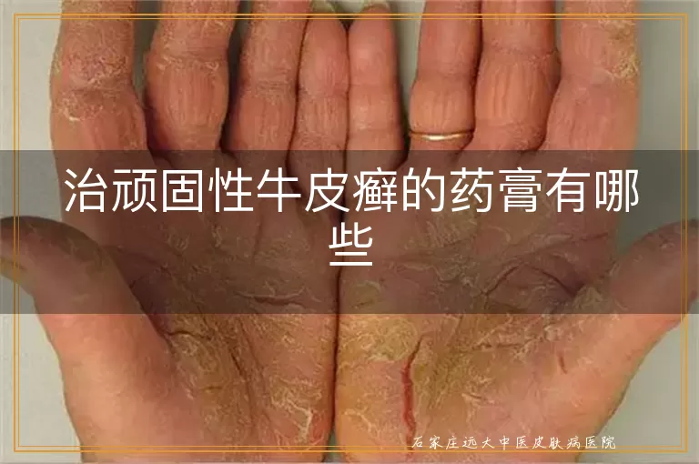 治顽固性牛皮癣的药膏有哪些