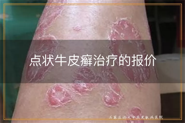 点状牛皮癣治疗的报价