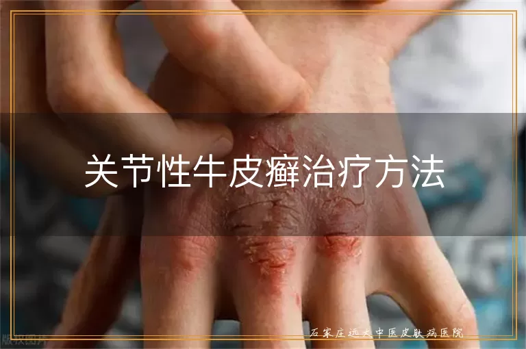 关节性牛皮癣治疗方法