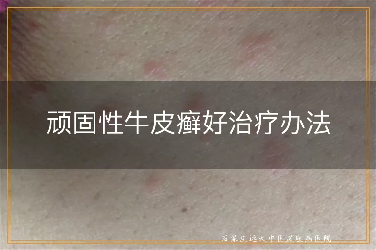 顽固性牛皮癣好治疗办法
