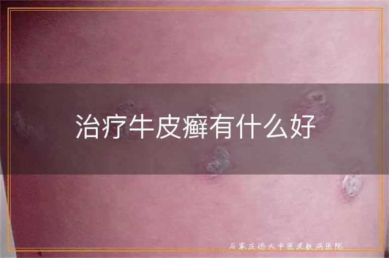 治疗牛皮癣有什么好