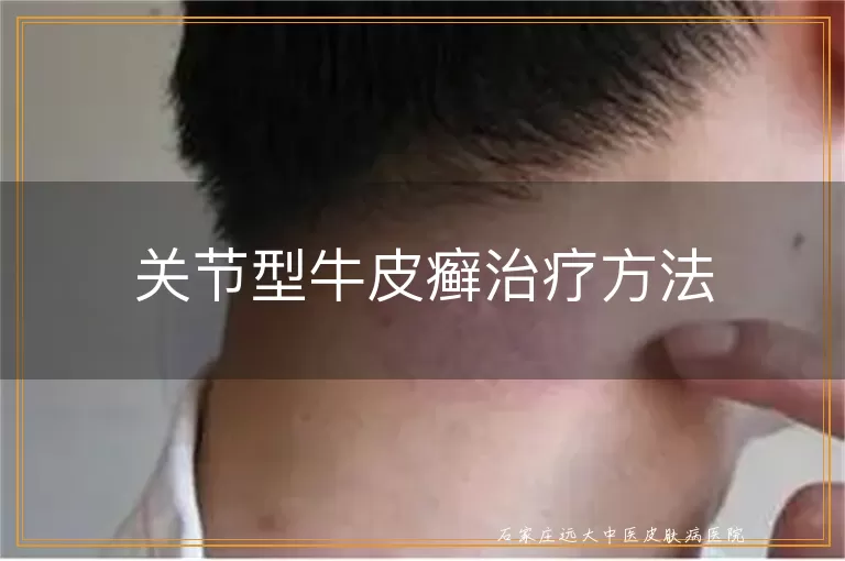 关节型牛皮癣治疗方法