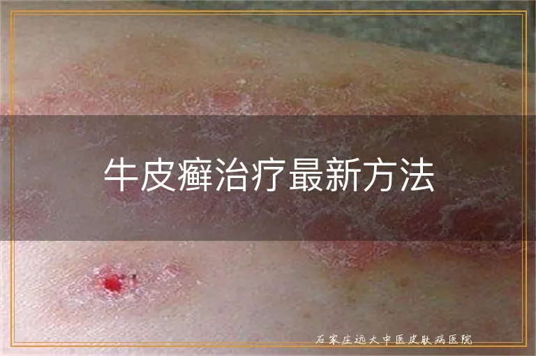 牛皮癣治疗最新方法
