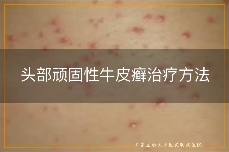 头部顽固性牛皮癣治疗方法
