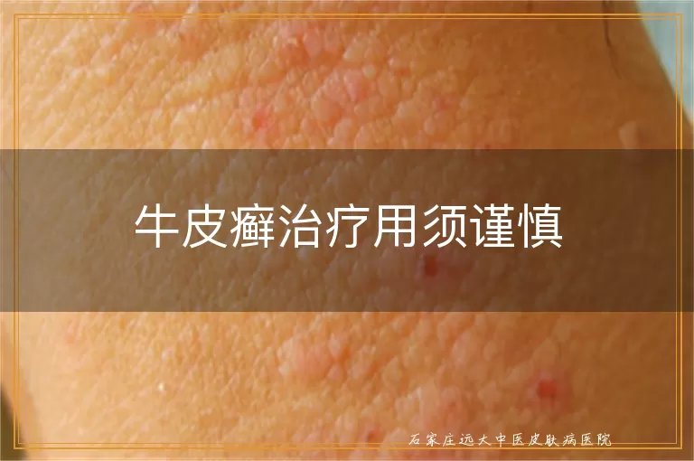 牛皮癣治疗用须谨慎