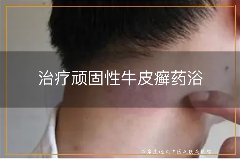 治疗顽固性牛皮癣药浴