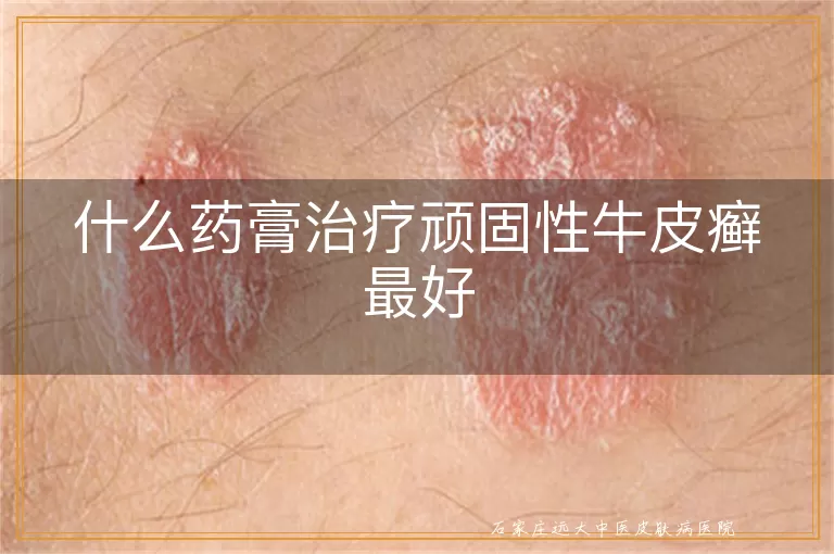 什么药膏治疗顽固性牛皮癣最好