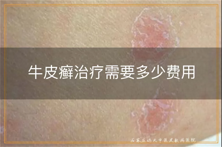 牛皮癣治疗需要多少费用