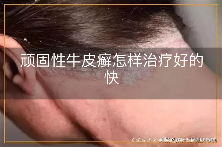 顽固性牛皮癣怎样治疗好的快