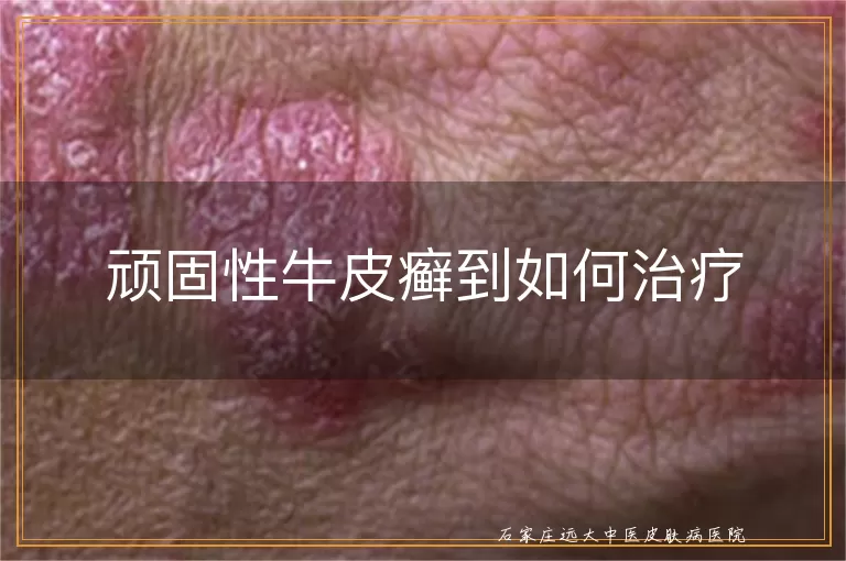 顽固性牛皮癣到如何治疗